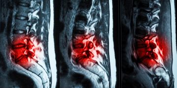 Инъекционный гидрогель эффективно избавит от болей в пояснице