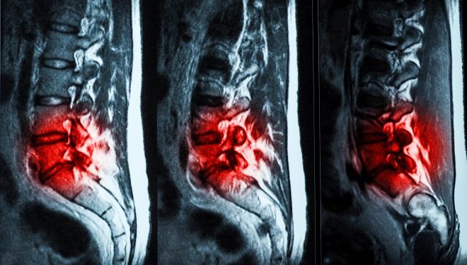 Инъекционный гидрогель эффективно избавит от болей в пояснице