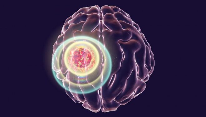 Инфракрасный имплант в черепе показал эффективность в борьбе с раком мозга