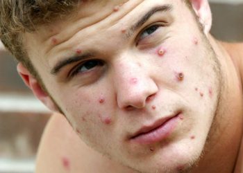 Почему текущей вспышки обезьяньей оспы не следует бояться