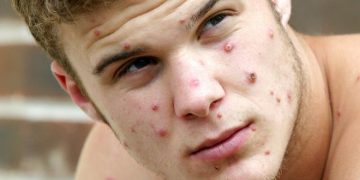 Почему текущей вспышки обезьяньей оспы не следует бояться