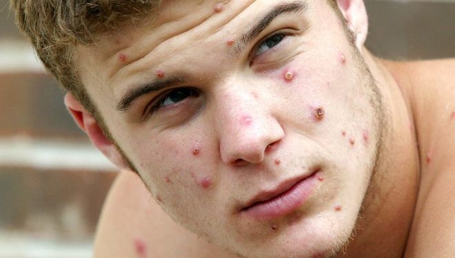 Почему текущей вспышки обезьяньей оспы не следует бояться