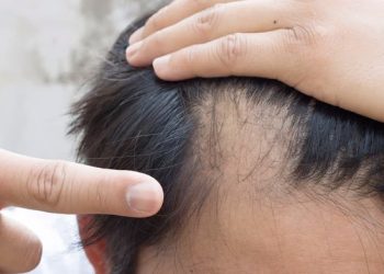 В США официально одобрили первое в своем роде лекарство от облысения