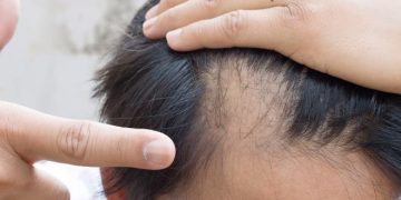 В США официально одобрили первое в своем роде лекарство от облысения