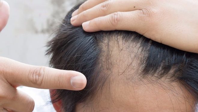 В США официально одобрили первое в своем роде лекарство от облысения