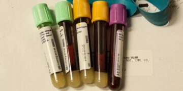 В Стэнфорде разработали анализ крови для определения скорости старения отдельных органов