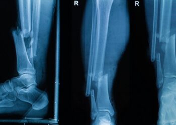 Клеевой пистолет позволит печатать заплатки для сломанных костей прямо во время операции