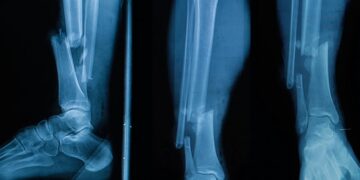 Клеевой пистолет позволит печатать заплатки для сломанных костей прямо во время операции