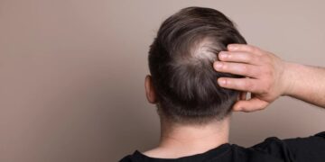 В США завершаются испытания первой эффективной таблетки от облысения