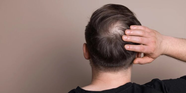 В США завершаются испытания первой эффективной таблетки от облысения