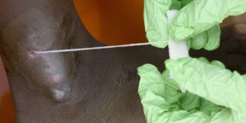 Человечество в шаге от полной победы над второй (после оспы) инфекционной болезнью в истории